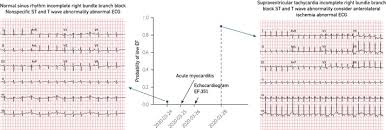 If there is also pericarditis, there are subtle changes that can sometimes be seen. Artificial Intelligence Ecg To Detect Left Ventricular Dysfunction In Covid 19 Mayo Clinic Proceedings