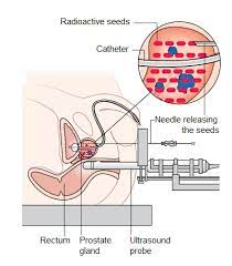 What doctors say you need to know. Prostate Cancer Symptoms Diagnosis Treatment Urology Care Foundation
