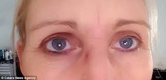 Nose dent marks from eyeglasses. Mother Of Five Dismissed Skin Cancer For A Glasses Mark Daily Mail Online