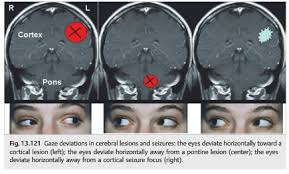 Image result for Eye Deviation
