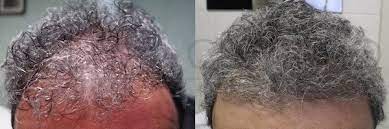 I poliambulatori medici tricomedit sono presenti a torino e alessandria da oltre 40. Autotrapianto Di Capelli Fut Fue Evitare La Calvizie