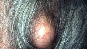 Image result for dry scabs on the head in children