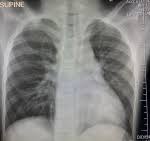 Guillain Barre Syndrome Associated With Covid 19 Infection
