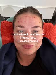 Hyaluronic Acid Serum Result
