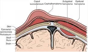 Image result for Vacuum Caput