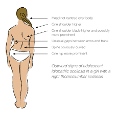 Simply defined, scoliosis is a sideways curve of the spine. Self Detection Fact Sheet Welcome To Scoliosis Australia