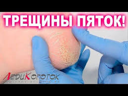 как избавиться от мозолей на ступнях в домашних условиях Kak Prosto Izbavitsya Ot Mozolej Na Nogah Narodnoe Sredstvo Mozol Udalenie A Ty Eto Znal Youtube Pedikyur Zdorove Lajfhaki Dlya Devushek