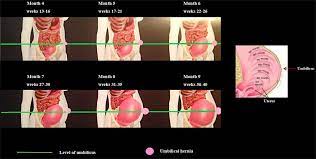 Frontiers Umbilical Hernia Repair And Pregnancy Before During After Surgery