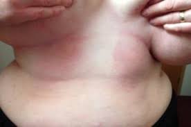 Image result for Intertrigo under breasts