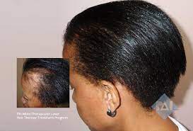 Black women in particular are prone to a type of hair loss called traction alopecia, which is caused by heat, chemicals and tight styles that pull at the hair root, including some braids, dreadlocks, extensions and weaves. Can Hair Loss Be Reversible Pai Hair Restoration Mclean Virginia
