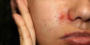 Hard pimples develop when dead skin cells and sebum (the oil in the skin), enter the pore causing the skin to become irritated and infected. Hard Pimples Meaning Causes Treatments And Prevention