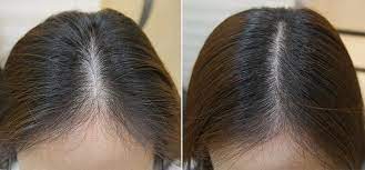 When vitamin d is low, the hair may thin or stop growing. Vitamin C Is Being Used To Treat Thinning Hair And The Results Are Incredible Newbeauty
