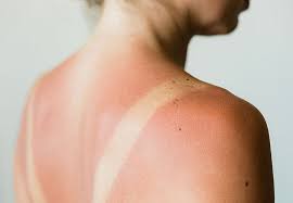 Resist the urge to scratch! How To Treat A Sunburn And Prevent It Next Time Health Essentials From Cleveland Clinic