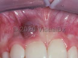 Image result for granuloma gum disease