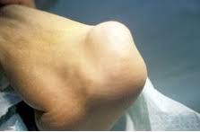 Der ellenbogen ragt als 330 bis 1200 meter breite landzunge, also langgestreckte halbinsel in die nordsee. Ellenbogen Medbaltic Orthopadie Unfallchirurgie Neurochirurgie