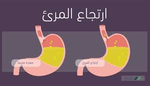 د مورفين R5 On Twitter أعراض ارتجاع المريء الشعور بحرقة في المعدة أو منطقة الصدر الحموضة عرض وليست مرض ألم في الصدر بالإنجليزية Chest Pain صعوبة في البلع القلس بالإنجليزية Regurgitation الغثيان