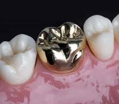 Porcelain crown fused to noble metal: How Much Does A Dental Crown Cost In Toronto Atlas Dental
