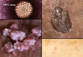 Image result for human papillomavirus symptoms