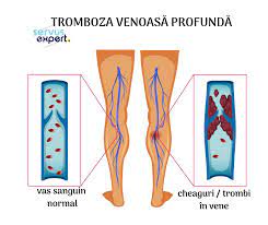 Tromboza venoasa profundă (tvp) este o afecţiune în care un cheag de sânge (tromb) se tromboza venoasă profundă poate provoca dureri de picior, dar de multe ori se produce fără nici un. Servusexpert Tromboza VenoasÄƒ ProfundÄƒ Este O AfecÈ›iune Facebook