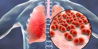 Mengenal penyakit paru paru basah pneumonia. 3 Penyebab Paru Paru Basah Yang Perlu Diwaspadai Halaman All Kompas Com