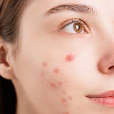 Image result for acne face