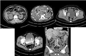 췌장은 위 뒤에 붙어있는 장기다. Abdomen Ct ë³µë¶€ ê²€ì‚¬ ê²€ì‚¬ ìˆ˜ìˆ  ì •ë³´ í•œì–'ëŒ€í•™êµë³'ì›