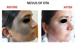 Nevus Of Ota Amrit Clinic