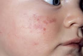 Un air inesthétique sur le visage et une sensation de gêne totale. Rougeurs Et Problemes De Peau En Images Babycenter Canada
