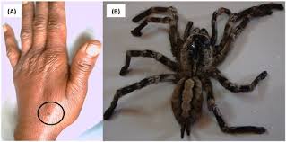 Image result for Tarantula Bite