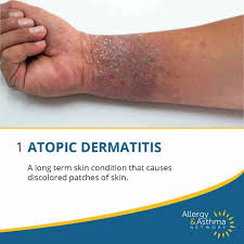 Image result for Atopic eczema atopic dermatitis