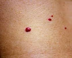 A person may develop a rash when high levels of uric acid in the blood cause crystals to form and accumulate in and around. Have You Noticed A Few Small Mysterious Spots Appearing On Your Skin Let S Take A Look And See If It Coul Skin Spots Purple Spots On Skin Varicose Vein Remedy