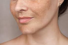 Image result for Melasma