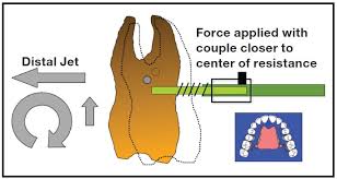 Lastly, activated springs were placed in the lingual sheaths of the upper first molar bands. Overview Upper Molar Distalization And The Distal Jet Jco Online Journal Of Clinical Orthodontics