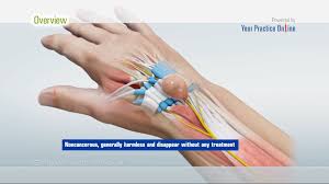 See full list on ryanhupfer.com Ganglion Cyst Removal Video Medical Video Library