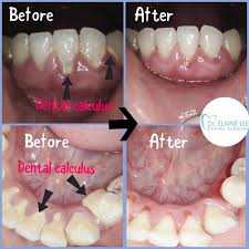 When plaque collects on teeth it hardens into tartar, also called dental calculus, on your teeth which can lead to serious gum disease. Dr Elaine Lee Dental Surgery Calculus Tartar And Scaling What Is Calculus Tartar Calcified Whitish Yellow Black Substance That Sticks To The Surface Of Your Teeth Especially Near The Gums They Cannot Be Brushed Off With