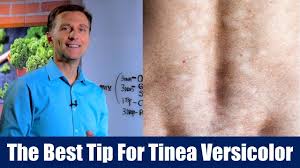 Clotrimazole (lotrimin af) cream or lotion Pin On Dr Berg S Videos