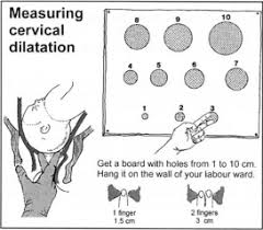 Measurement Of Cervical Dilatation