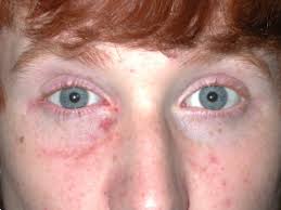 Check spelling or type a new query. Photos Of Trauma Orbital And Zygoma Fractures Eyelid Plastic Surgery
