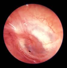  acute suppurative otitis media is defined as suppurative infection involving the mucosa of the middle ear cleft. Acute Otitis Media