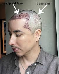 2024 was the year that I accepted and did my hair transplant. I carried  this burden over year after year, but 2024 was the year to do something  about it. I have