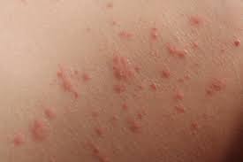 Image result for dermatitis contacta children