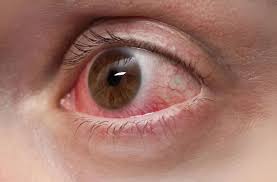 Image result for Keratitis