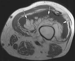 Spectrum Of Fat Containing Soft Tissue Masses At Mr Imaging The Common The Uncommon The Characteristic And The Sometimes Confusing Radiographics
