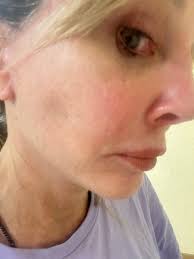 Has anyone had or researched the micro surgeries? I found this in a search  and have heard of someone who was in the hospital a few days for "draining"  . This was