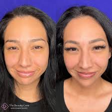 𝑼𝒏𝒍𝒐𝒄𝒌 𝒀𝒐𝒖𝒓 𝑻𝒓𝒖𝒆 𝑩𝒆𝒂𝒖𝒕𝒚✨ • 2 syringes of Restylane Lyft  used to volumize the Cheeks, 1ml of Restylane Contour to help restore mid  face volume, 1 syringe of Restylane Lyft to decrease