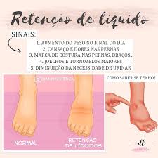Cansaço Fisico E Mental Dor Nas Pernas A Retencao De Liquidos E Ocasionado Por Um Acumulo Excessivo De Liquidos Noa Tecidos Pode Ser Causado Por Problema Beauty Design Instagram Marketing Massage