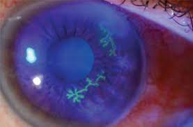 It begins with infection of epithelial cells on the surface of the eye and retrograde infection of nerves serving the cornea. Herpes Keratitis Core Em