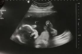 * * werbung für kindofrosy hair. Ultraschallbilder Mehr Als 50 Bilder Aus Der Schwangerschaft Faminino