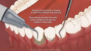 Read all about plaque and teeth: Gingivitis
