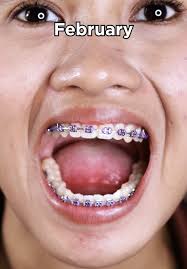 I found my community! 🚫🦷❤️⛸️ #MissingTeeth #ToothFairy #SkatingCoach...